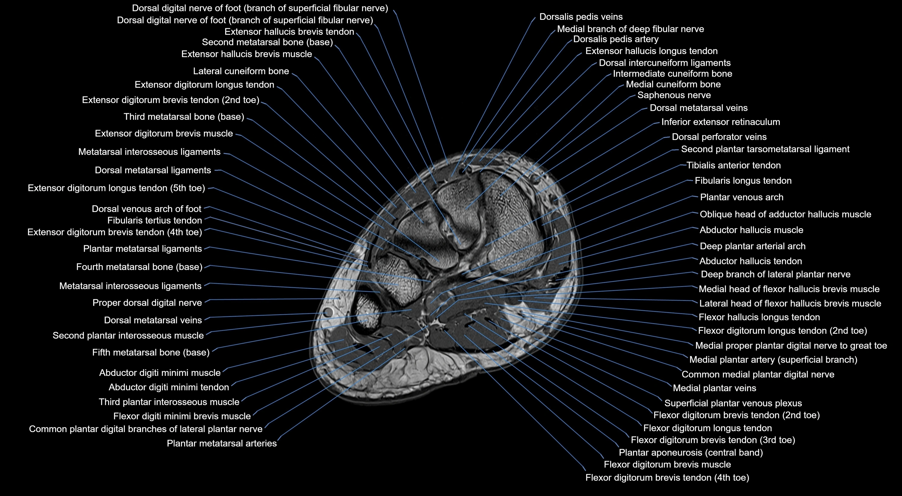 MRI mid foot coronal ligaments cross sectional anatomy 3T  radiology  image-img-00001-00017.webp